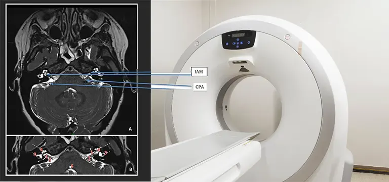 A Complete Guide To MRI Vertigo Protocol Uses Preparation Procedure and Benefits